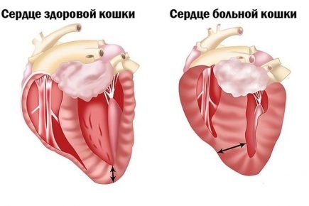 Сердечная недостаточность