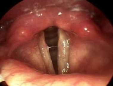 Отёчная слизистая оболочка гортани при ларингите
