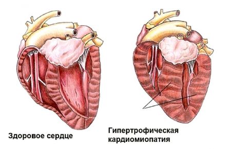 Гипертрофическая кардиомиопатия