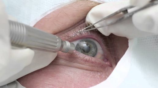 Глазная операция
